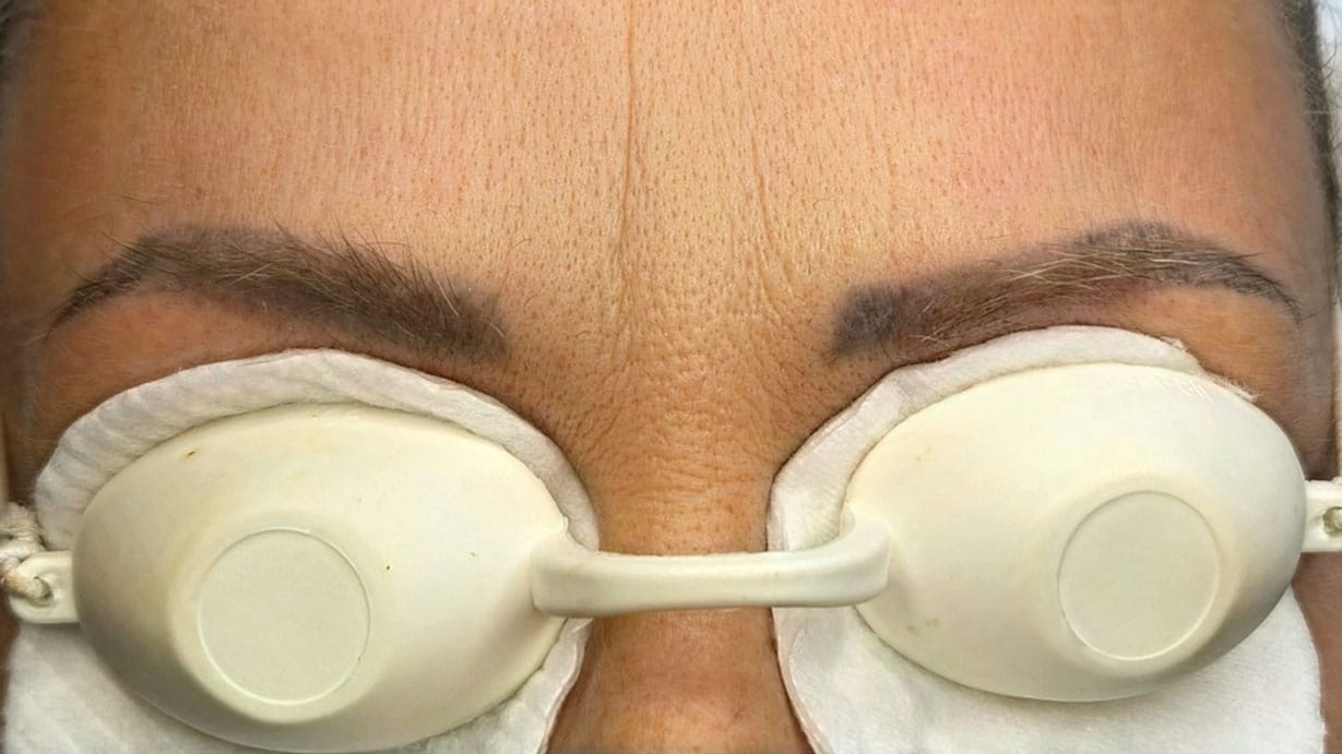 Permanentā grima pigmenta izvadīšana pēc procedūras - 5
