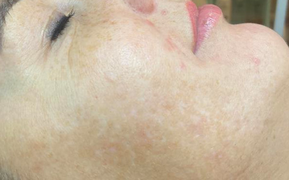 DermaCeutic Cosmo Peel rezultāts pēc procedūras